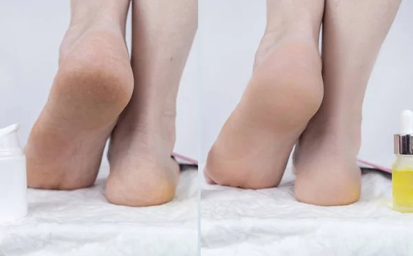 Express Heel Softening Peel